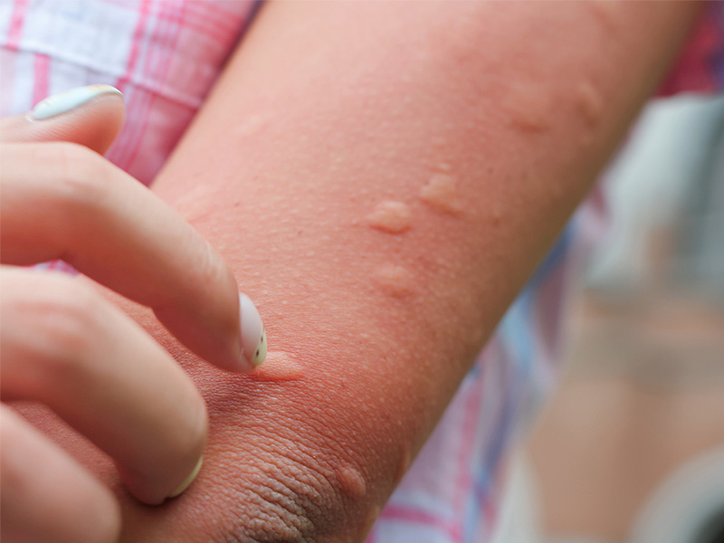mosquito bites on arm
